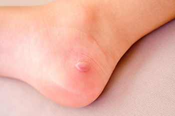 Popping of Foot Blisters