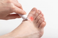 Drug Resistant Fungal Foot Infections