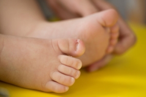 Ingrown Toenails 101