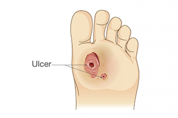 Diabetic sole hotsell