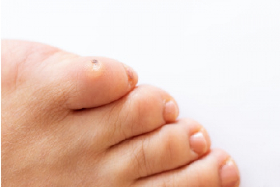 Corn under little toe sales
