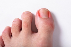 A Podiatrist’s Approach to Ingrown Toenails