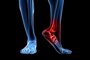 What Leads to Heel Pain?