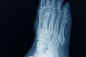 Clarifying Misconceptions of Cuboid Syndrome